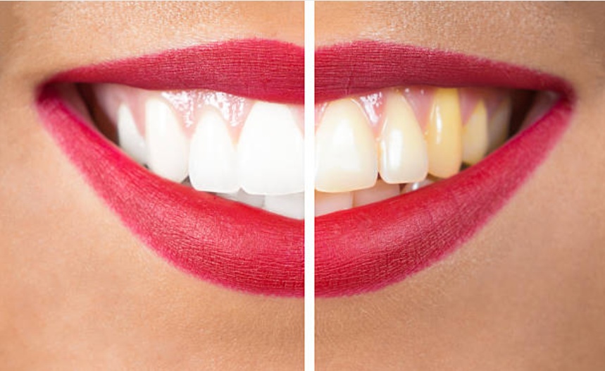 Teeth before and after