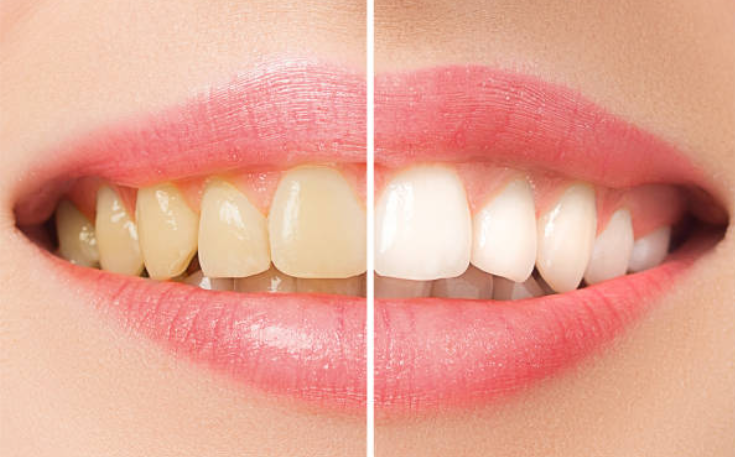 Teeth before and after