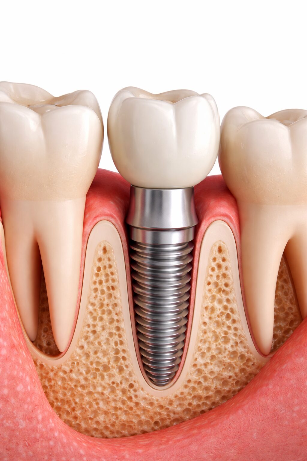 Implant dentar București Implant dentar București