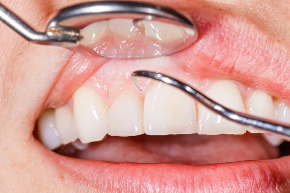 Parodontoză – sănatatea gingiilor și a dinților Parodontoză - sănatatea gingiilor și a dinților