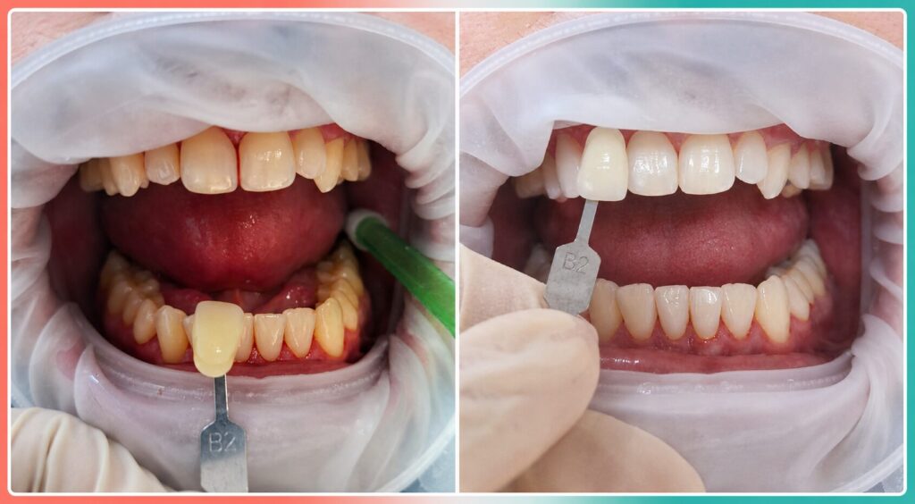 Pacient albire dentara laser