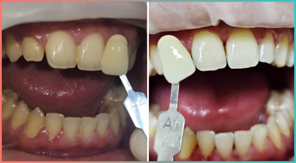 Pacient albire dentara laser